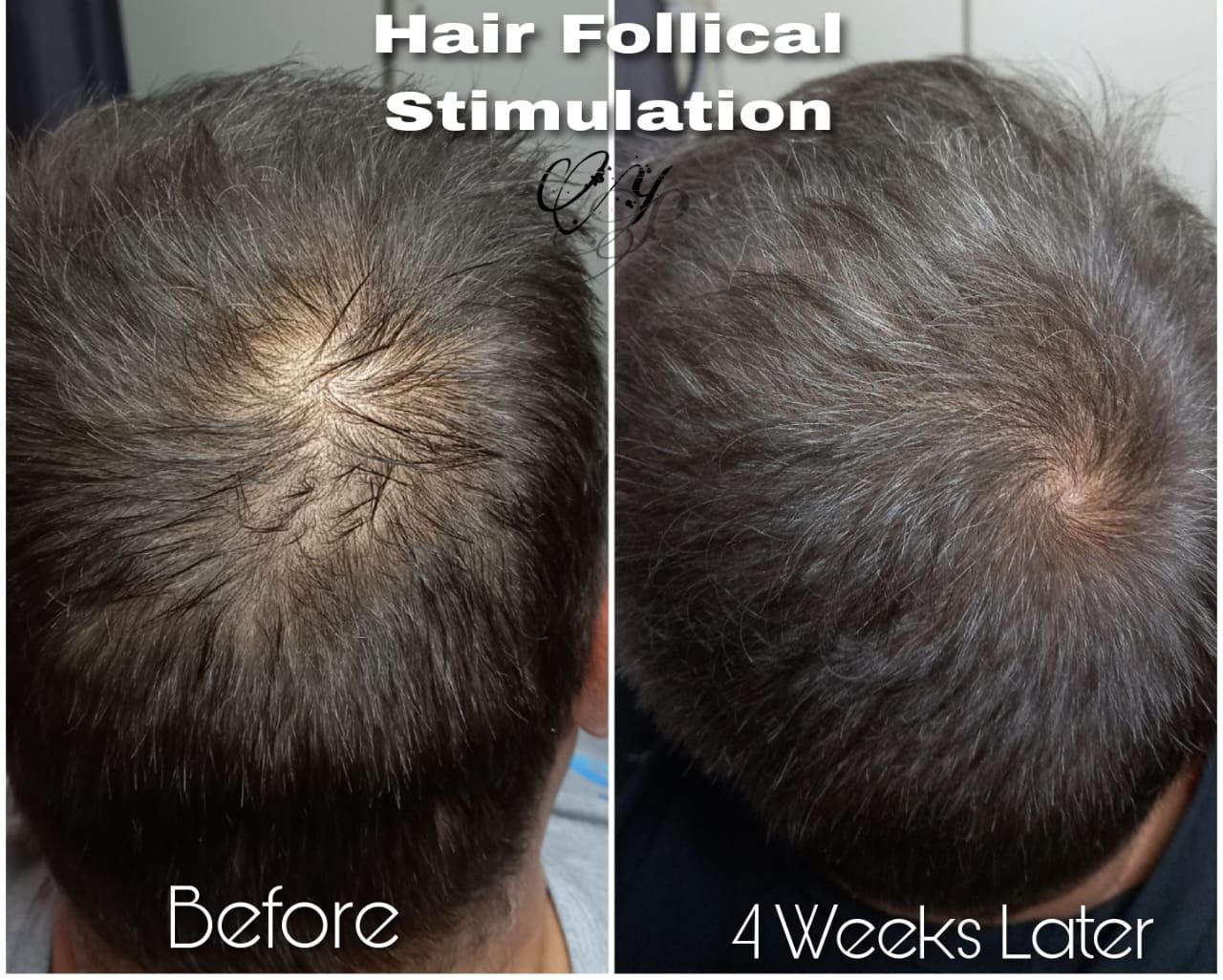Before and after — Follicular Stimulation