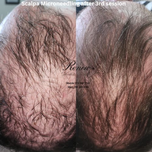 Before and after — Scalp Microneedling Series